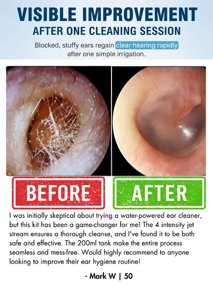 ENT-Approved Home Ear Irrigation Micro-Clinic System – German-Engineered Vortex Pulse Wax Removal Kit Compliant with AAO-HNS Guidelines (Save $1400+ on Clinic Visits!)